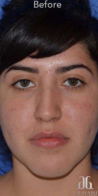 Ethnic Rhinoplasty Before & After Patient #6832