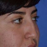 Ethnic Rhinoplasty Before & After Patient #6832