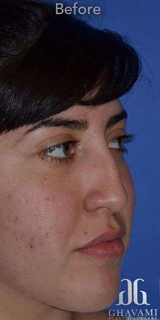 Ethnic Rhinoplasty Before & After Patient #6832