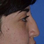 Ethnic Rhinoplasty Before & After Patient #6832