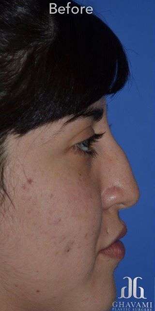 Ethnic Rhinoplasty Before & After Patient #6832