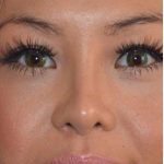 Ethnic Rhinoplasty Before & After Patient #6816