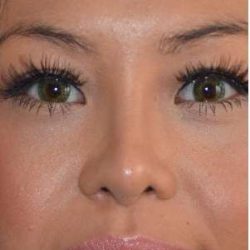 Ethnic Rhinoplasty Before & After Patient #6816