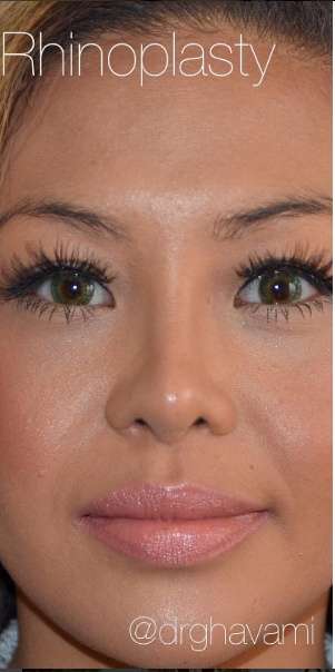 Ethnic Rhinoplasty Before & After Patient #6816