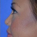 Ethnic Rhinoplasty Before & After Patient #6816