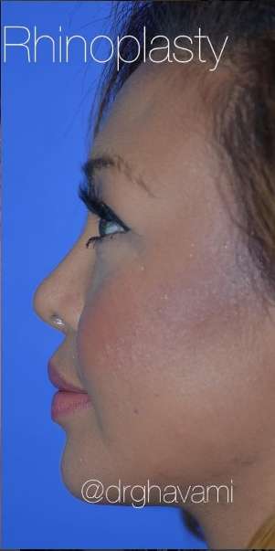 Ethnic Rhinoplasty Before & After Patient #6816