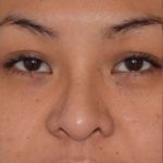 Ethnic Rhinoplasty Before & After Patient #6816