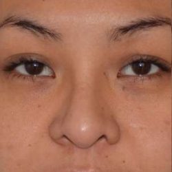 Ethnic Rhinoplasty Before & After Patient #6816