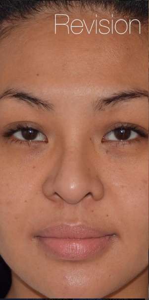 Ethnic Rhinoplasty Before & After Patient #6816