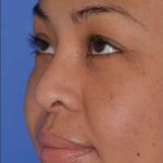 Ethnic Rhinoplasty Before & After Patient #6816