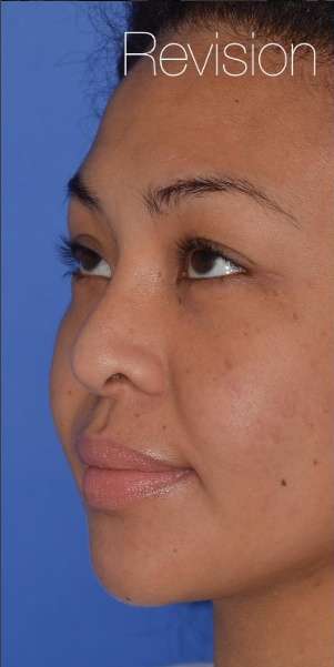 Ethnic Rhinoplasty Before & After Patient #6816