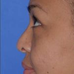 Ethnic Rhinoplasty Before & After Patient #6816