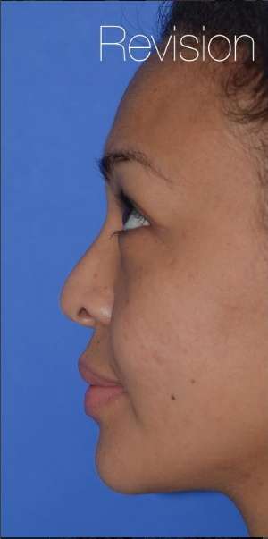 Ethnic Rhinoplasty Before & After Patient #6816