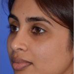 Ethnic Rhinoplasty Before & After Patient #6809