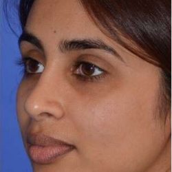Ethnic Rhinoplasty Before & After Patient #6809