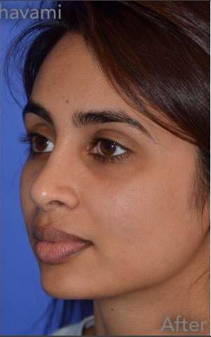 Ethnic Rhinoplasty Before & After Patient #6809