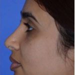 Ethnic Rhinoplasty Before & After Patient #6809