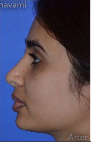 Ethnic Rhinoplasty Before & After Patient #6809