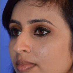 Ethnic Rhinoplasty Before & After Patient #6809