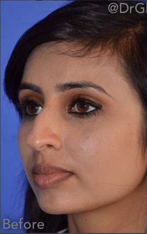 Ethnic Rhinoplasty Before & After Patient #6809