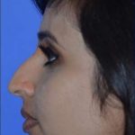 Ethnic Rhinoplasty Before & After Patient #6809