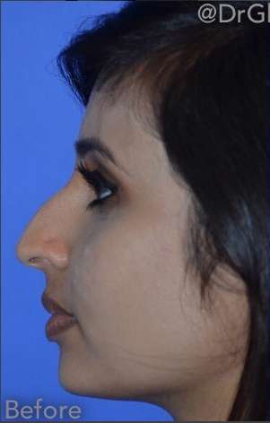 Ethnic Rhinoplasty Before & After Patient #6809