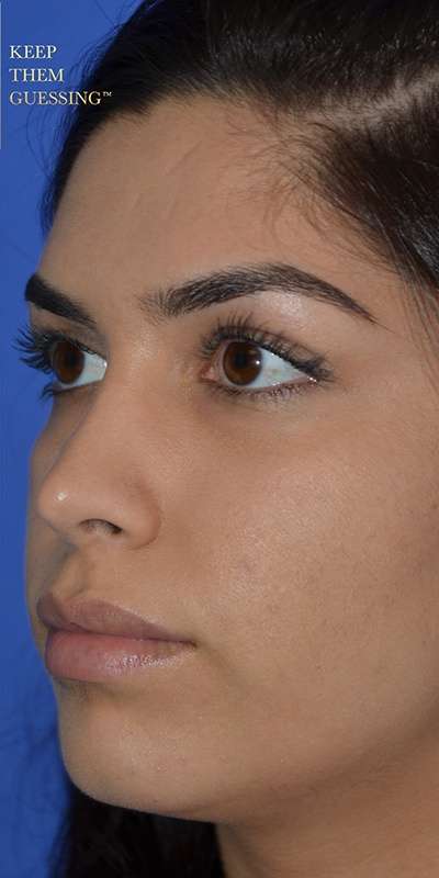 Revision Rhinoplasty Before & After Patient #6790