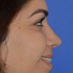 Revision Rhinoplasty Before & After Patient #6790