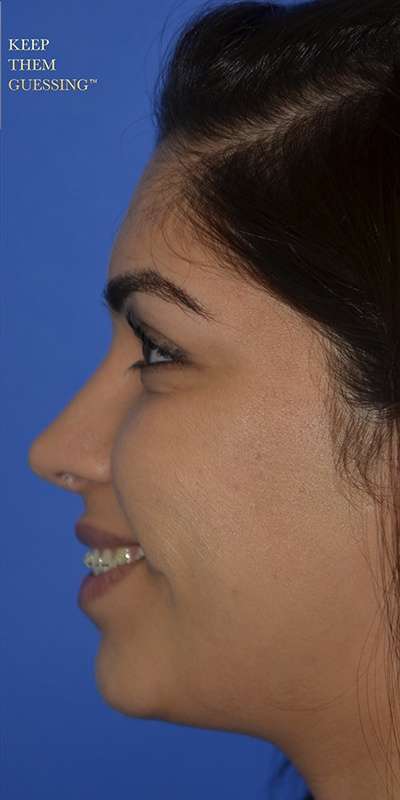 Revision Rhinoplasty Before & After Patient #6790