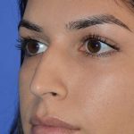 Revision Rhinoplasty Before & After Patient #6790