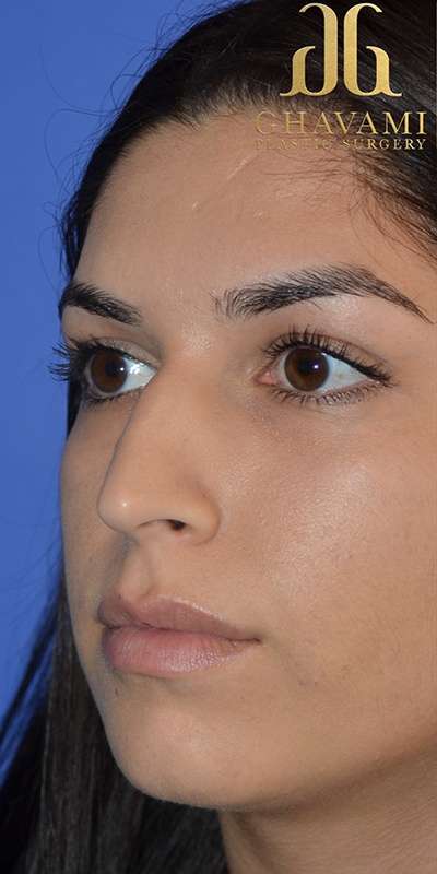 Revision Rhinoplasty Before & After Patient #6790