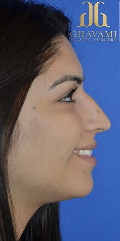 Revision Rhinoplasty Before & After Patient #6790