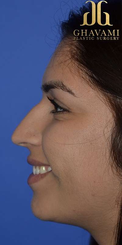 Revision Rhinoplasty Before & After Patient #6790