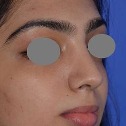 Revision Rhinoplasty Before & After Patient #6783