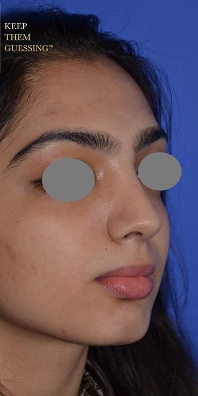 Revision Rhinoplasty Before & After Patient #6783