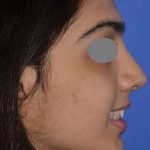 Revision Rhinoplasty Before & After Patient #6783