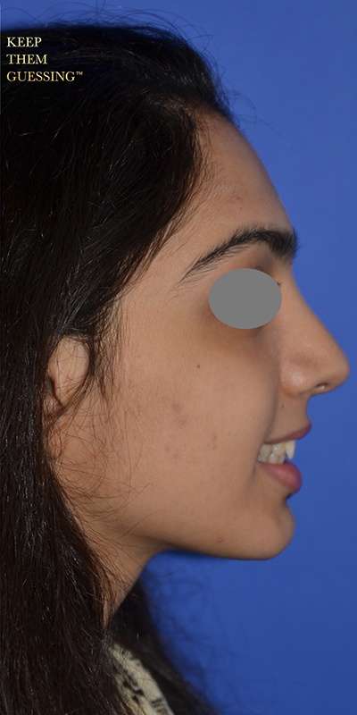 Revision Rhinoplasty Before & After Patient #6783