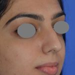 Revision Rhinoplasty Before & After Patient #6783
