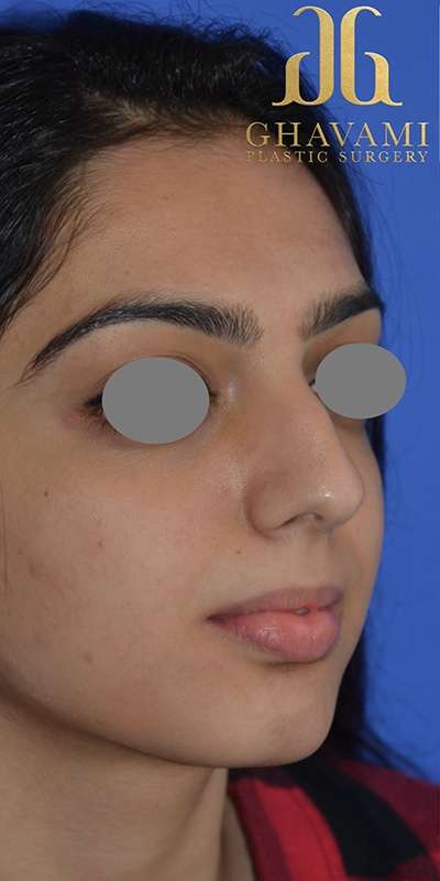 Revision Rhinoplasty Before & After Patient #6783