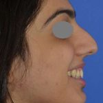 Revision Rhinoplasty Before & After Patient #6783