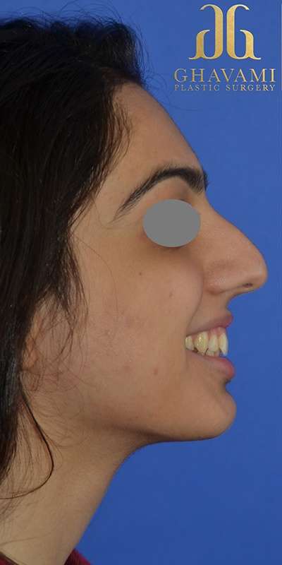 Revision Rhinoplasty Before & After Patient #6783