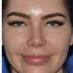 Rhinoplasty Before & After Patient #6769