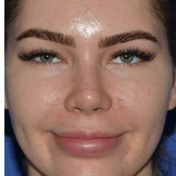 Rhinoplasty Before & After Patient #6769