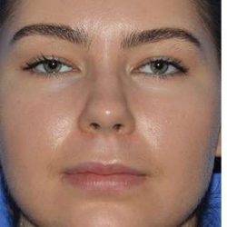 Rhinoplasty Before & After Patient #6769