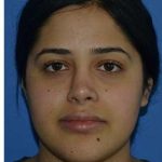 Ethnic Rhinoplasty Before & After Patient #6766