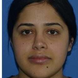 Ethnic Rhinoplasty Before & After Patient #6766