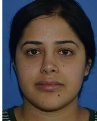 Ethnic Rhinoplasty Before & After Patient #6766
