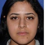 Ethnic Rhinoplasty Before & After Patient #6766
