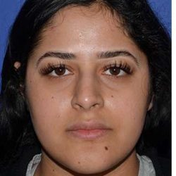 Ethnic Rhinoplasty Before & After Patient #6766