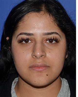 Ethnic Rhinoplasty Before & After Patient #6766